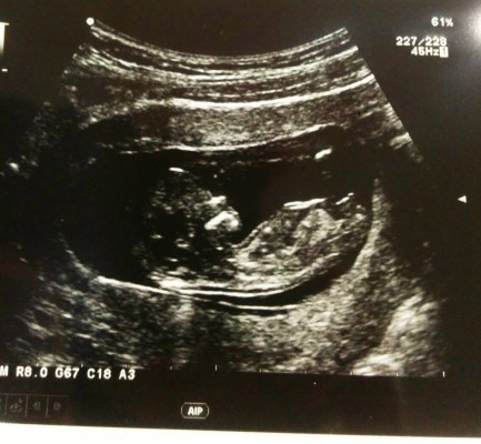 first trimester ultrasound scan.jpg